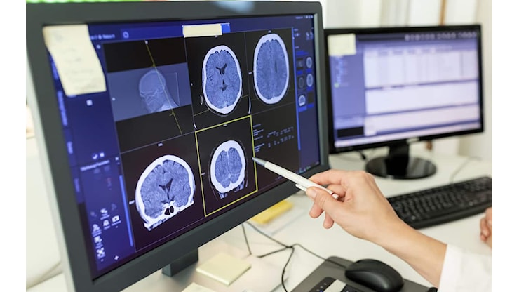 Glioblastoma, cos'è il raro tumore al cervello che ha colpito Sophie Kinsella: sintomi e cure - Sky TG24